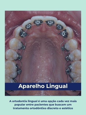 aparelho lingual polaroid (1)