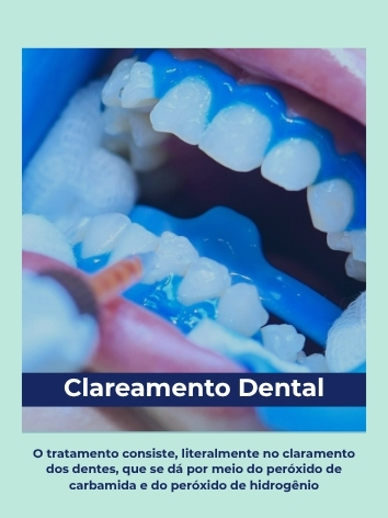 clareamento dental polaroid (1)