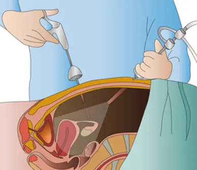 Laparoscopia diagnóstica